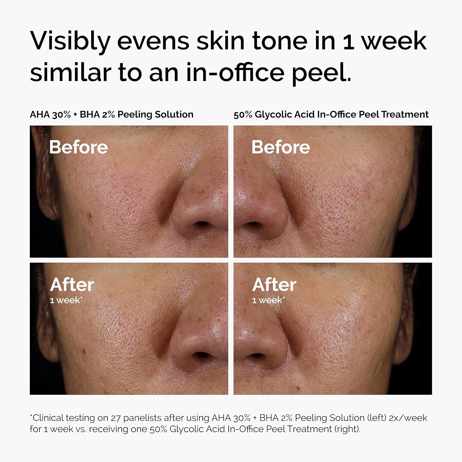 image:imageThe Ordinary AHA 30 BHA 2 Peeling Solution Advanced Exfoliating Peel for Brighter SkinExfoliate Hydrate Serum Duo