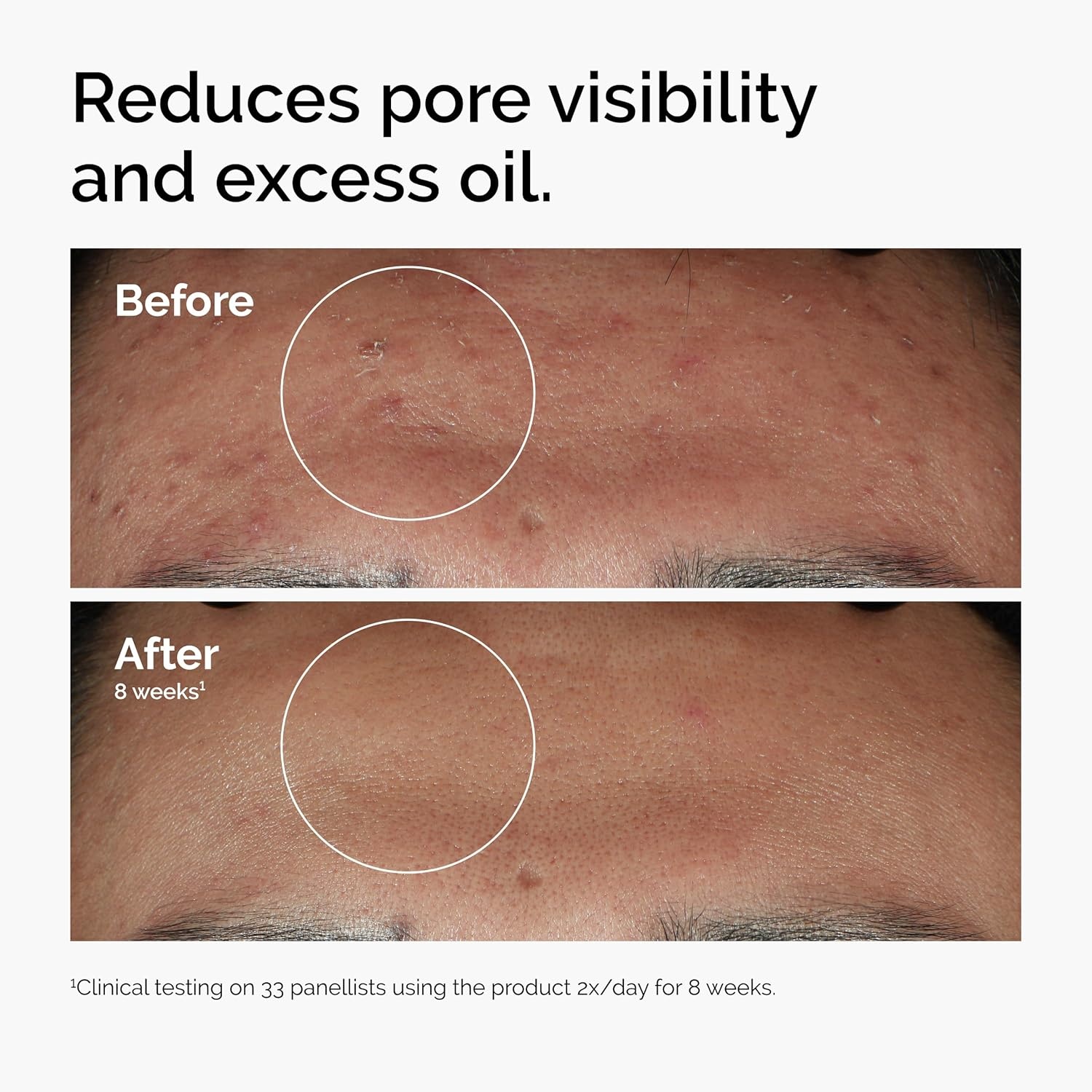 image:imageThe Ordinary Niacinamide 10 Zinc 1 Smoothing Serum for BlemishProne Skin1 Fl Oz Pack of 2