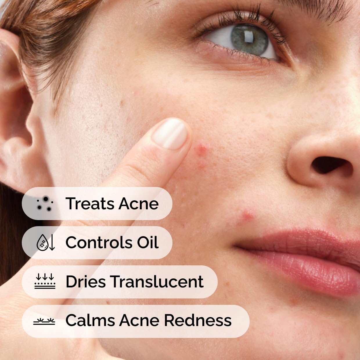 image:imageThe Ordinary Sulfur 10 PowdertoCream Acne Spot Treatment Concentrate Reduces Pimple Size and Zit Redness 018 Oz018 Ounce Pack of 1