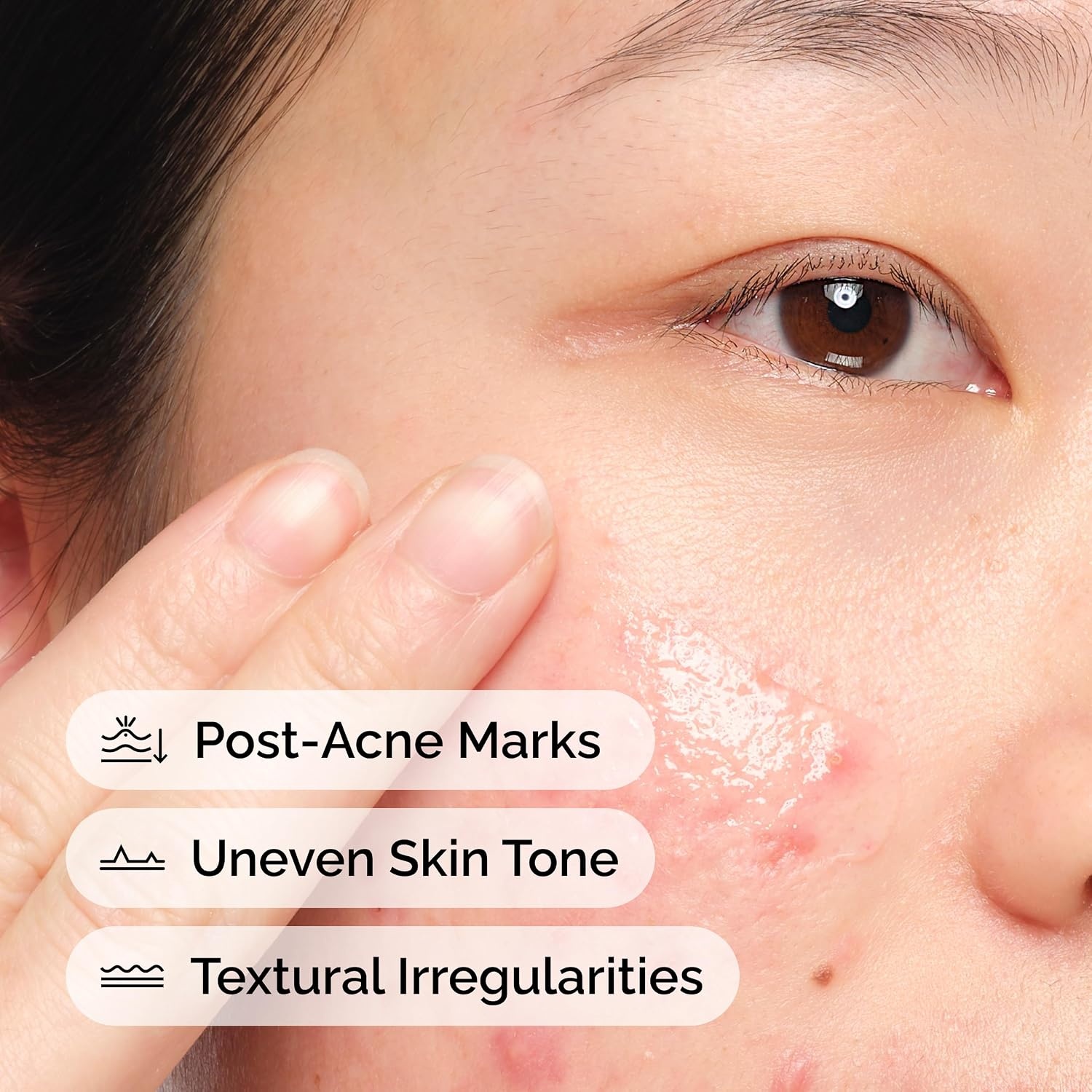image:imageThe Ordinary Aloe 2 NAG 2 Solution Soothes Skin and Targets PostAcne Marks 1 Fl Oz
